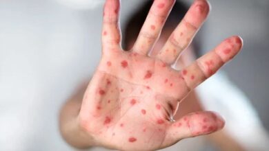 Measles in pakistan