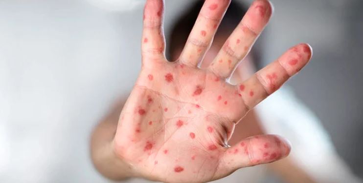 Measles in pakistan