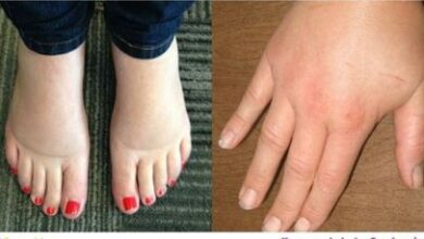 feet and hands swelling