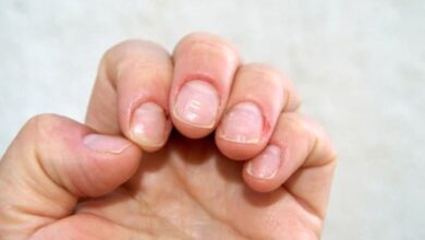 Marks on the nails