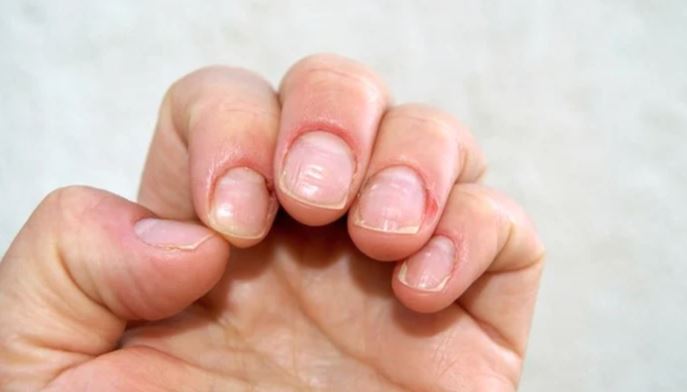 Marks on the nails