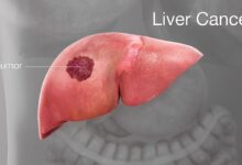liver cancer