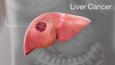 liver cancer