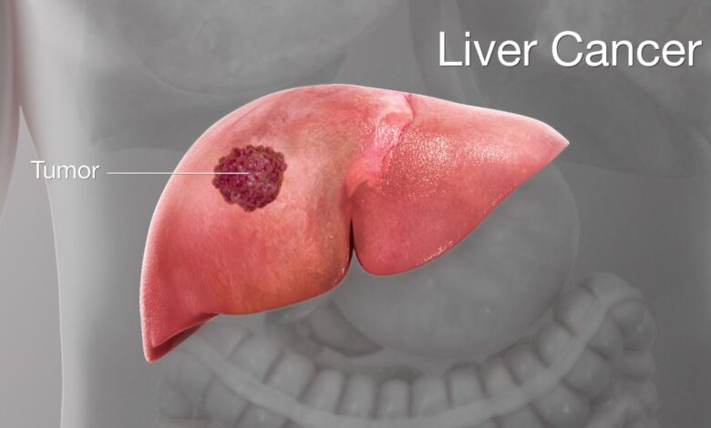 liver cancer