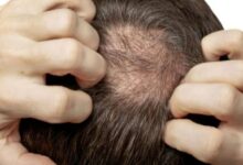 Discovering a simple and effective treatment for baldness