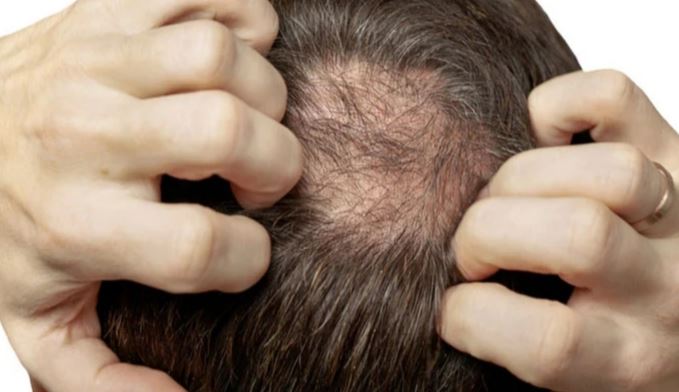 Discovering a simple and effective treatment for baldness